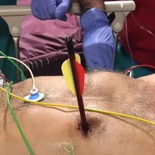 Notizie dal Piemonte. Arriva in ospedale con una freccia piantata nel cuore: salvato alle Molinette con un intervento senza precedenti