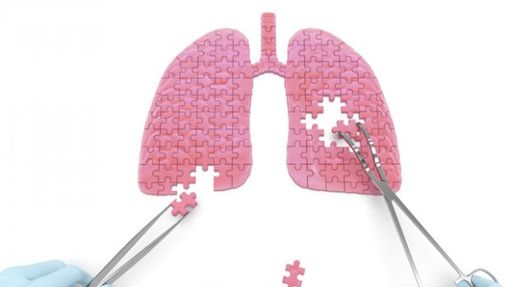 Chirurgia toracica miniinvasiva per la cura dei tumori del polmone: 400 casi di lobectomia polmonare anatomica video-assistita