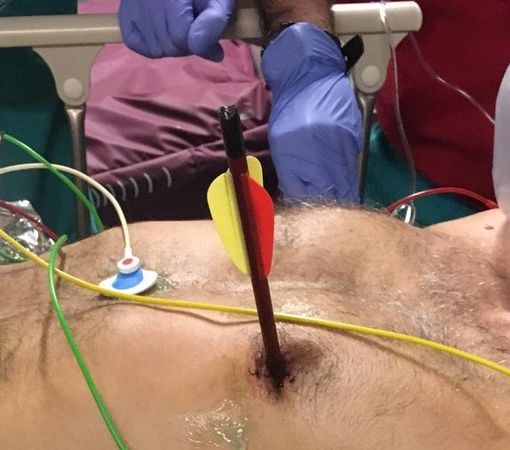 Notizie dal Piemonte. Arriva in ospedale con una freccia piantata nel cuore: salvato alle Molinette con un intervento senza precedenti