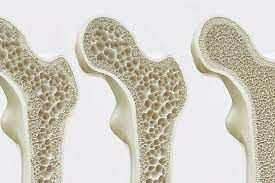 Ad Arona lo screening gratuito contro l’osteoporosi