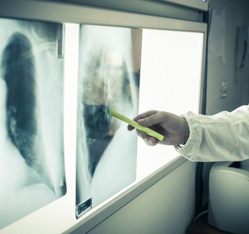 Lotta ai tumori dopo il Covid: &quot;La gente deve ricominciare a fare screening, ma servono anche specialisti&quot; VIDEO