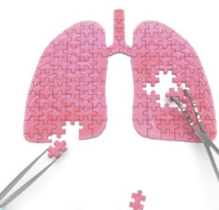 Chirurgia toracica miniinvasiva per la cura dei tumori del polmone: 400 casi di lobectomia polmonare anatomica video-assistita