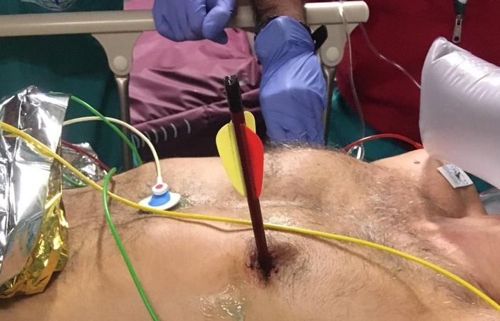 Notizie dal Piemonte. Arriva in ospedale con una freccia piantata nel cuore: salvato alle Molinette con un intervento senza precedenti
