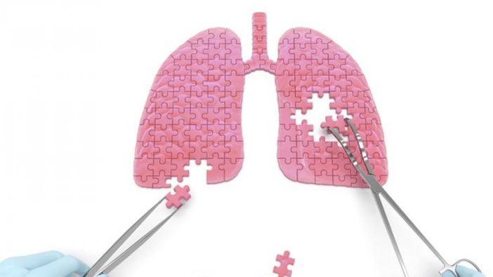 Chirurgia toracica miniinvasiva per la cura dei tumori del polmone: 400 casi di lobectomia polmonare anatomica video-assistita