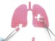 Chirurgia toracica miniinvasiva per la cura dei tumori del polmone: 400 casi di lobectomia polmonare anatomica video-assistita