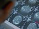 Fenilchetonuria, 'screening neonatale evita danni neurologici ma serve continuità assistenziale' Fenilchetonuria, 'screening neonatale evita danni neurologici ma serve continuità assistenziale'