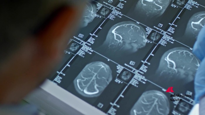 Fenilchetonuria, 'screening neonatale evita danni neurologici ma serve continuità assistenziale'