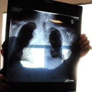 Tumori, in carcinoma polmonare risultati positivi da combinazione in prima linea