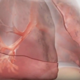 Innovazioni terapeutiche nella BPCO con enfisema