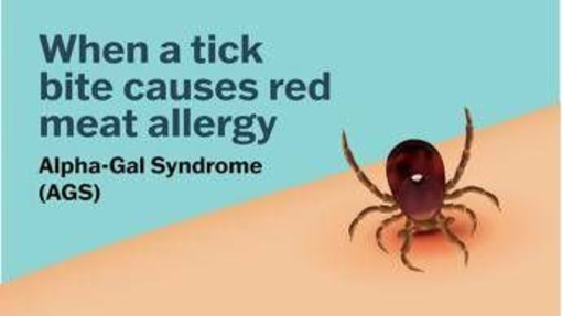 Se una zecca rende allergici a carne e latticini, cos'è la sindrome alfa-gal