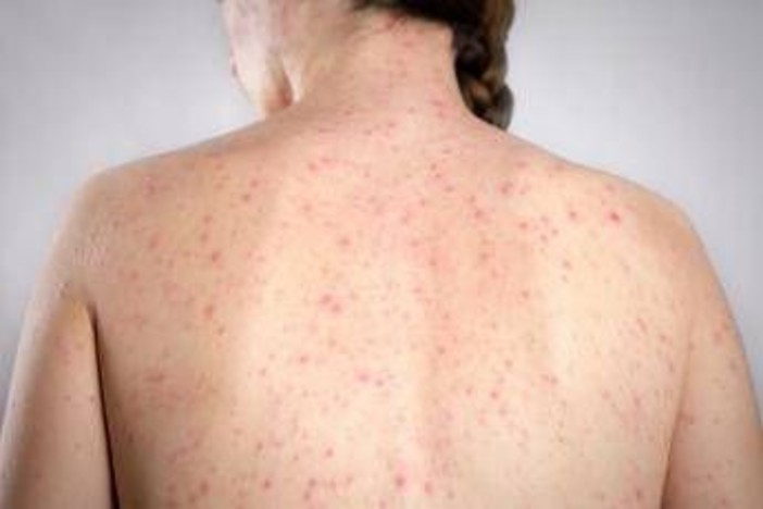 Morbillo, è allarme negli Usa. Italia prima per casi in Europa in in primi 6 mesi 2026 Morbillo, è allarme negli Usa. Italia prima per casi in Europa in in primi 6 mesi 2026