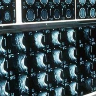 Ipofosfatemia legata all'X, primo bilancio e prospettive su linee guida