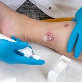 Idrosadenite suppurativa, quando fare la doccia o dormire diventano ostacoli