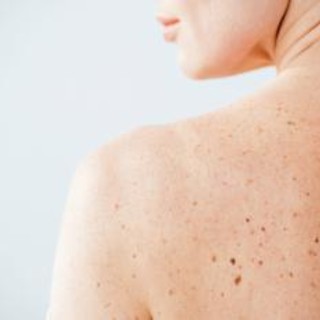 Nei e sole, Sidemast lancia la Giornata della prevenzione dermatologica