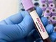Giornata patologie eosinofile, allergologo Caminati: "Diagnosi complessa"