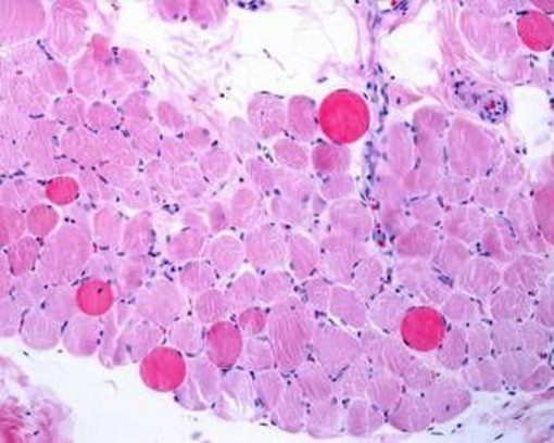 Malattie rare, risultati positivi a 5 anni per vamorolone in distrofia Duchenne