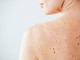 Nei e sole, Sidemast lancia la Giornata della prevenzione dermatologica