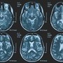 Tumori, glioma pediatrico di basso grado: via libera in Europa a prima terapia mirata