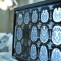 Giornata mondiale dell'Alzheimer, neurologi: &quot;Ora percorsi cura più efficaci e sostenibili&quot;