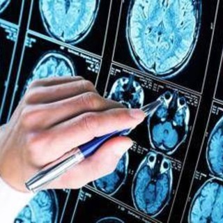 Farmaci, ok Ema a donanemab, neurologi: &quot;Svolta in lotta all'Alzheimer&quot;