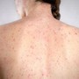 Morbillo, è allarme negli Usa. Italia prima per casi in Europa in in primi 6 mesi 2026