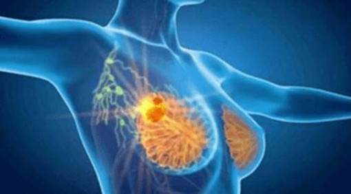Cancro seno, con profilazione molecolare e terapie target migliori prospettive di cura Cancro seno, con profilazione molecolare e terapie target migliori prospettive di cura