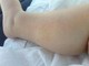 Dermatite atopica, Aifa estende rimborso di upadacitinib dai 12 anni di età