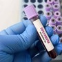 Giornata patologie eosinofile, allergologo Caminati: "Diagnosi complessa"